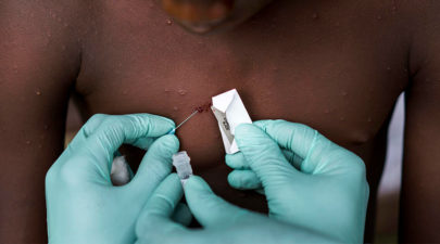 monkeypox examination africa facebook 1200x628 1