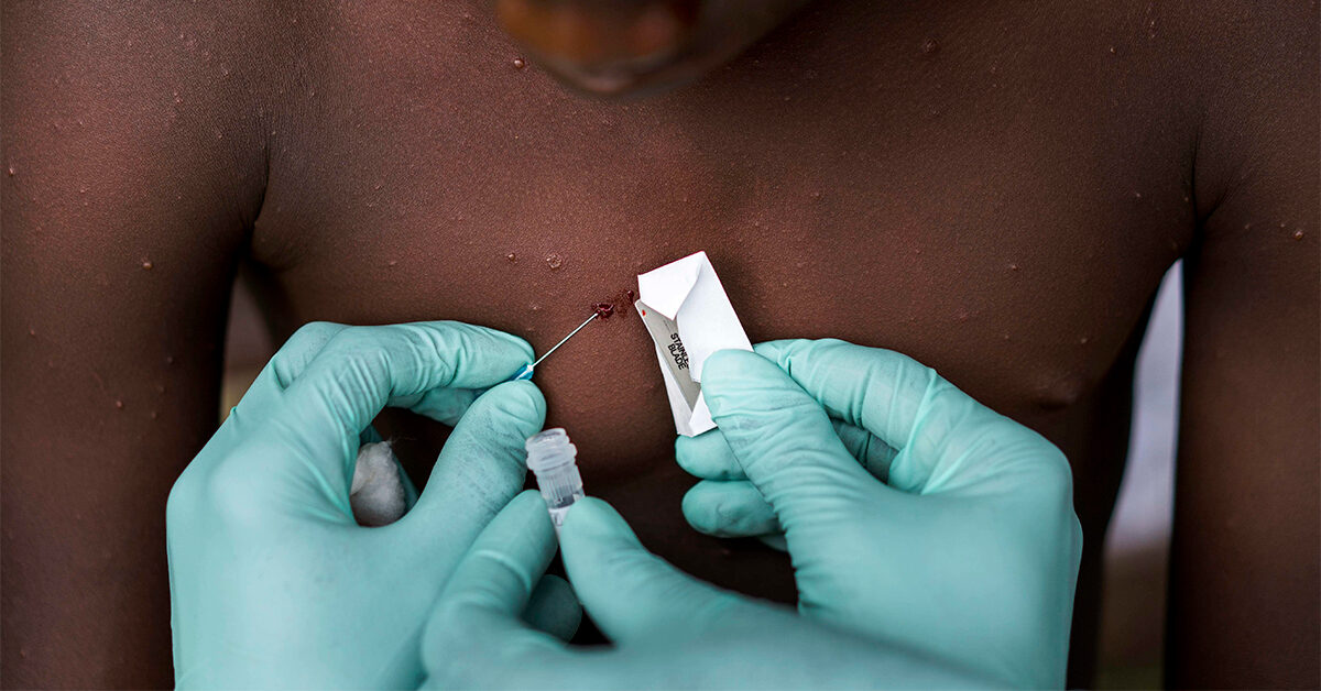 monkeypox examination africa facebook 1200x628 1