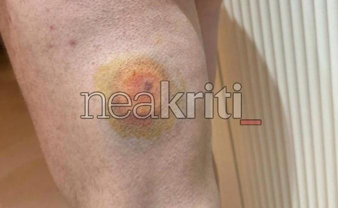 Φωτογραφία για: Αγρότες: Οι αστυνομικοί τους πυροβόλησαν με πλαστικές σφαίρες στην Κρήτη - Φωτογραφίες ντοκουμέντο 3 agrotes_plastikes_sfaires_2