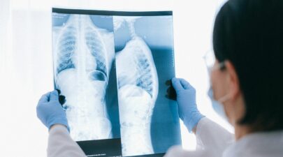 πνευμονιόκοκκος